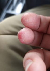Пальцы с контактным дерматитом